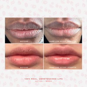 SOS LipSoftie® Lip Treatment