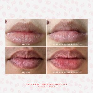 LipSoftie® Lip Treatment Set