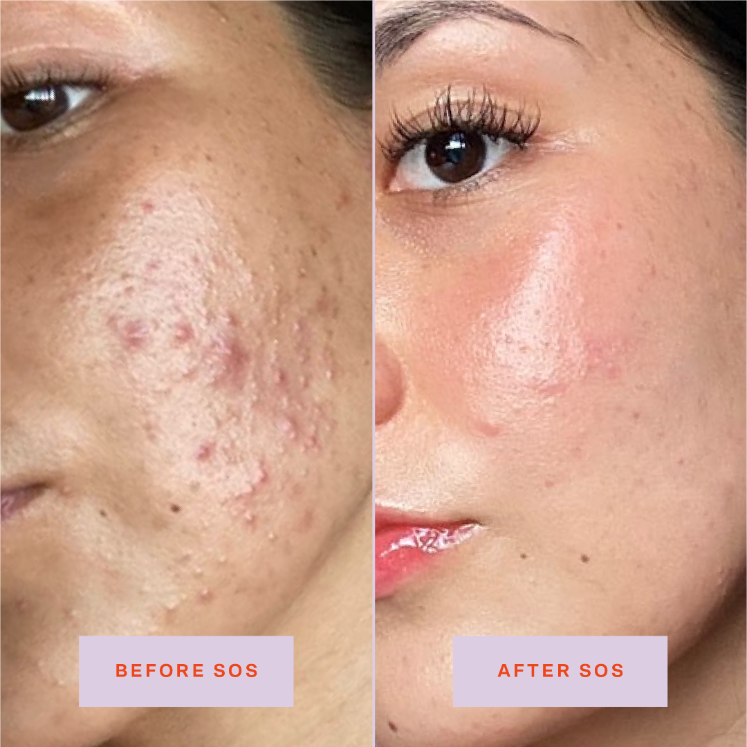 Tower28SOSBeforeAfterAcne_2f5293b4-3d0c-4ed5-aaa7-cd8290e46e63.png